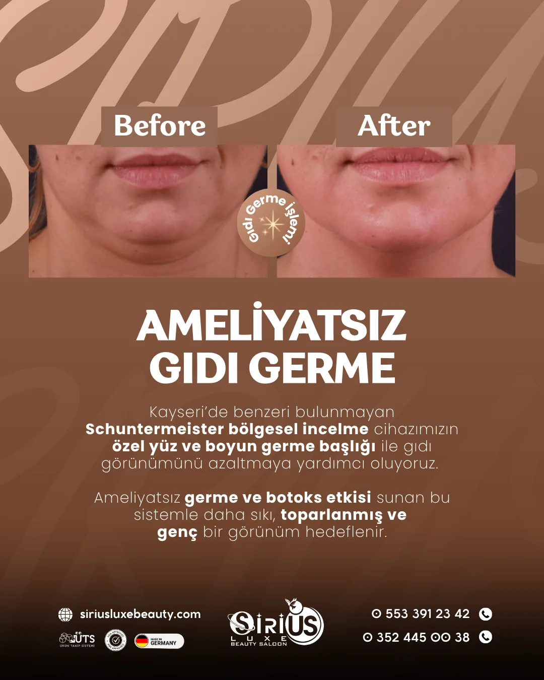 Ameliyatsız gıdı germe öncesi ve sonrası tanıtım görseli