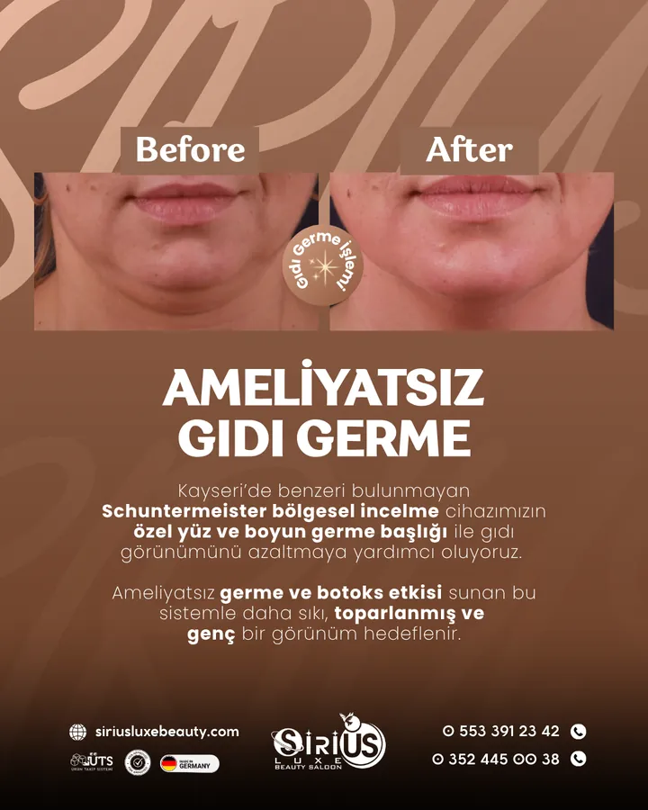 Ameliyatsız Gıdı Germe